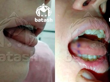 Стоматолог разорвал россиянке язык бормашиной